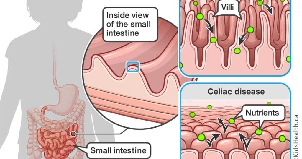 What is Celiac Disease